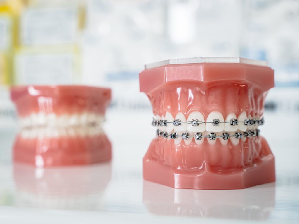 braces